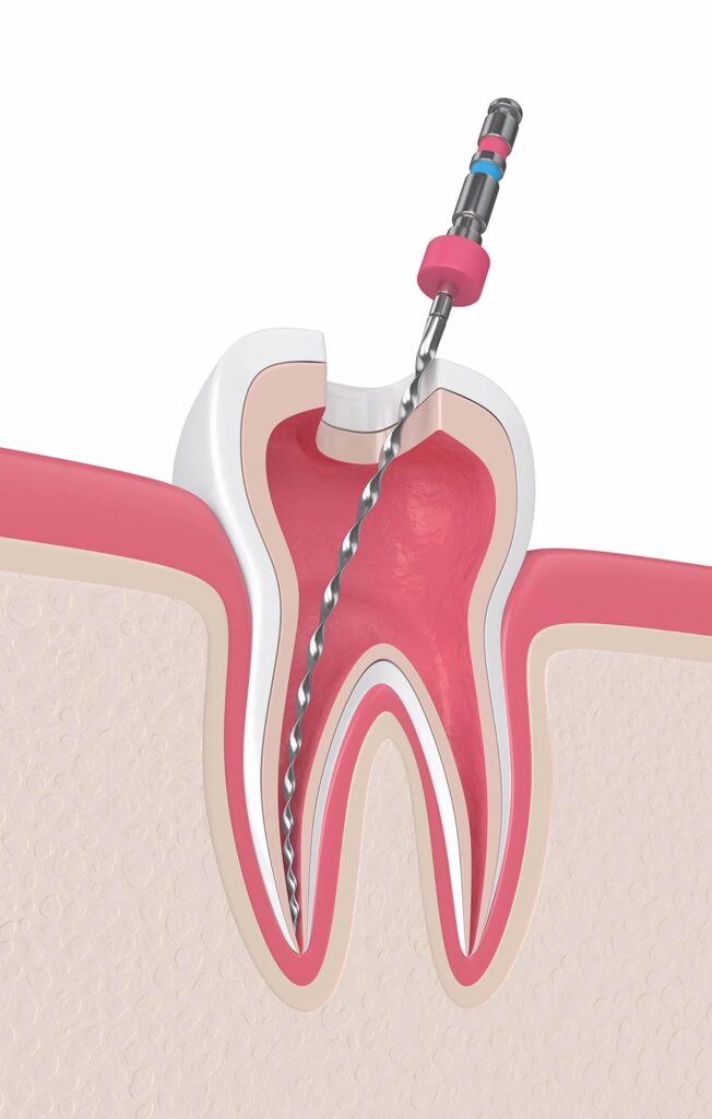 Endodoncia diente Clinica dental Marbán, Valladolid.