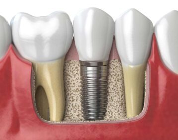 Implantes Clinica dental Marbán, Valladolid.
