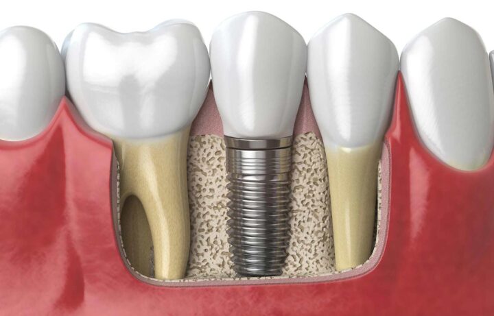 Implantes Clinica dental Marbán, Valladolid.